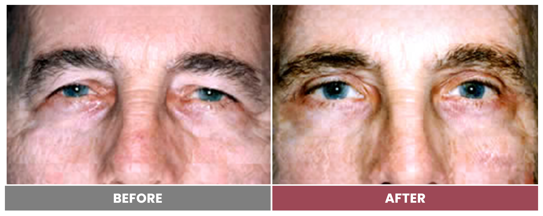 Upper Blepharoplasty - Case 92